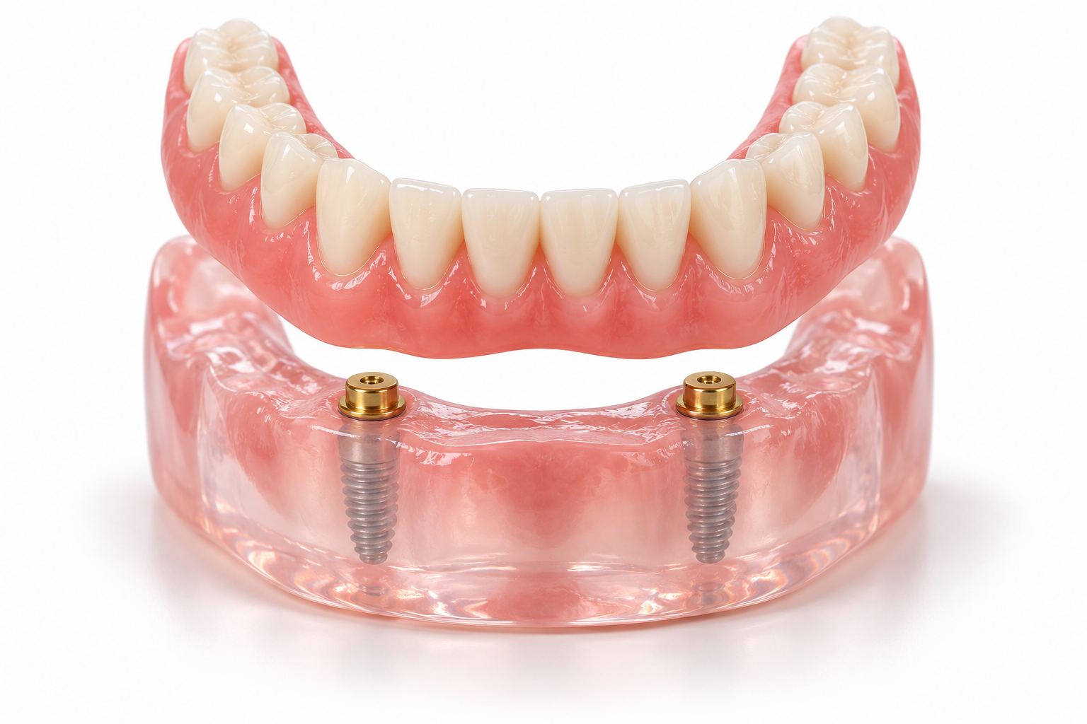 All on X dental implant model showing how titanium implants anchor a full arch of teeth at Tri-City Dental Oceanside