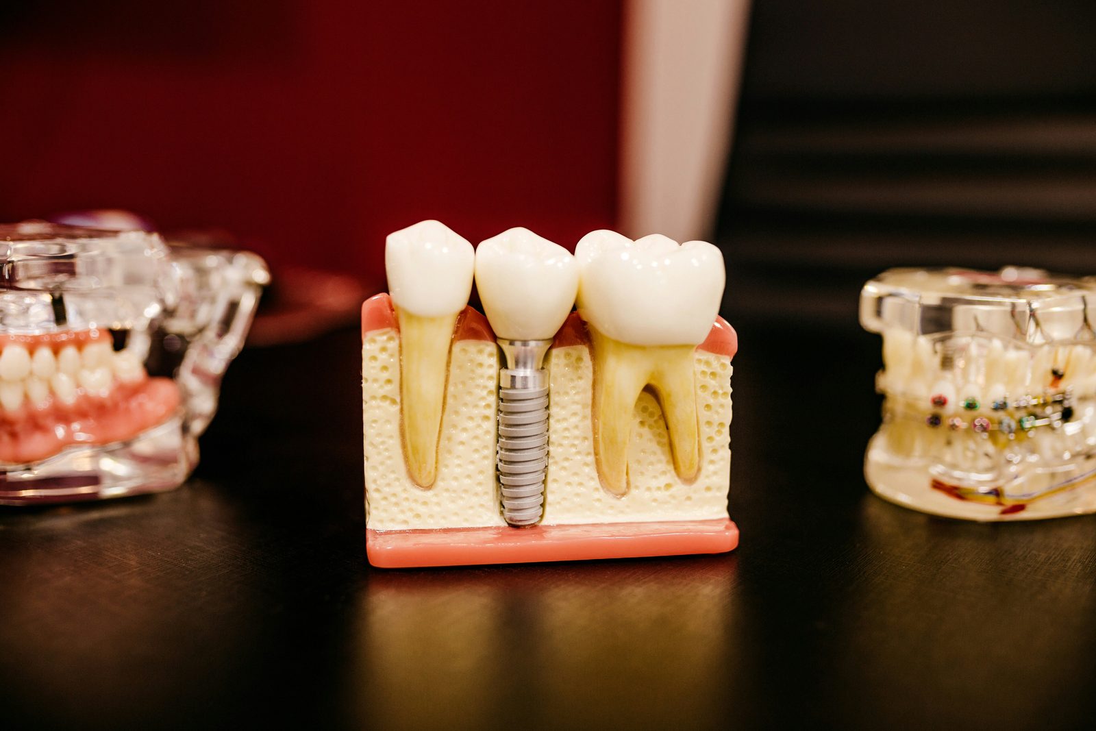 Dental implant cross-section model showing titanium post, abutment, and crown